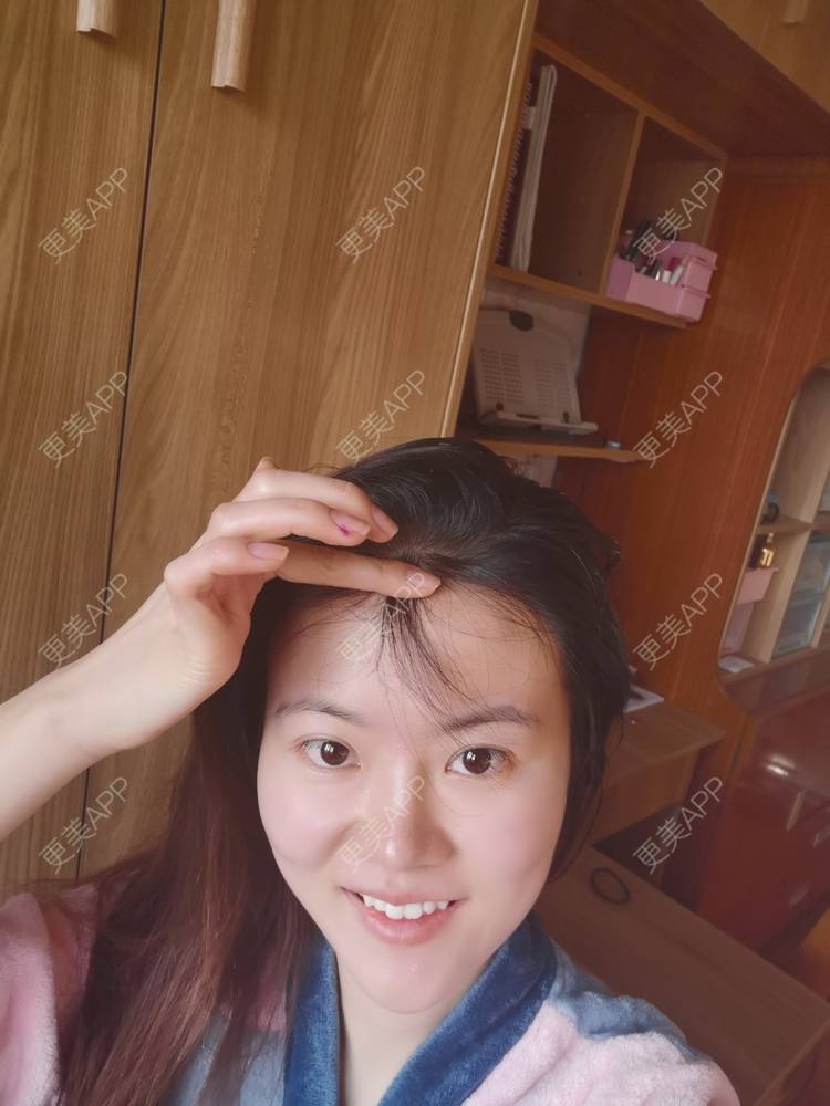 更美 - umgsd的植发际线经验 | 植发际线 | 上海