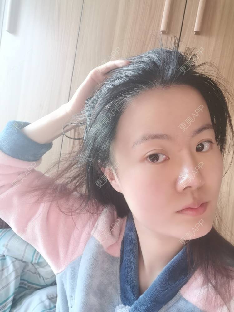 更美 - umgsd的植发际线经验 | 植发际线 | 上海