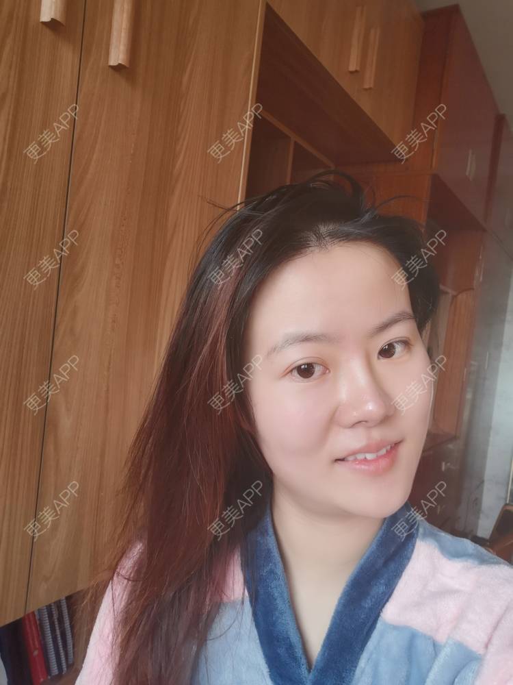 更美 - umgsd的植发际线经验 | 植发际线 | 上海