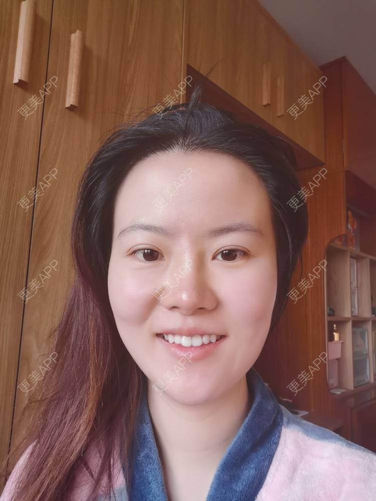 更美 - umgsd的植发际线经验 | 植发际线 | 上海