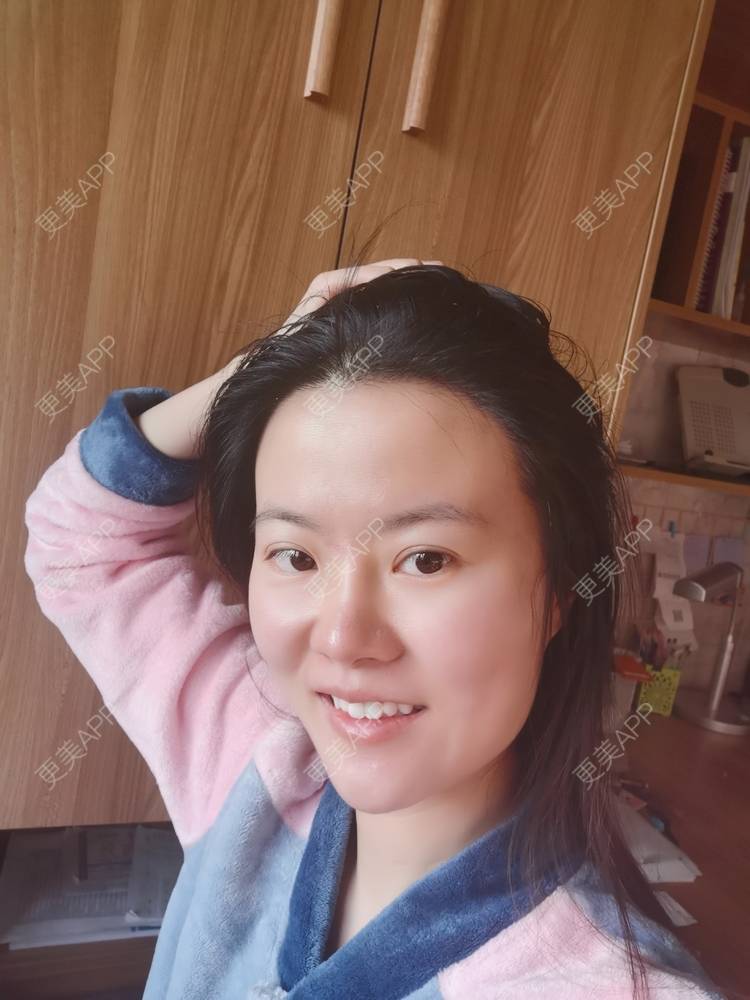 更美 - umgsd的植发际线经验 | 植发际线 | 上海