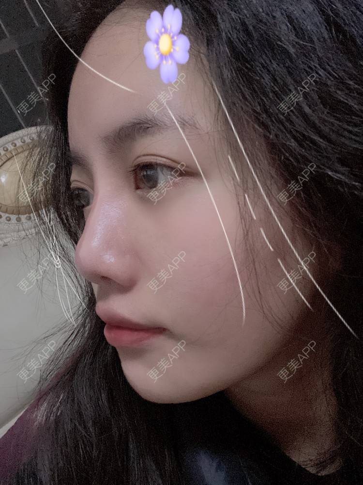 更美 - Dd酱哦的隆鼻经验 | 耳软骨隆鼻 | 硅胶隆鼻 | 隆鼻 | 鼻部多项 | 自体软骨垫鼻尖 | 温州