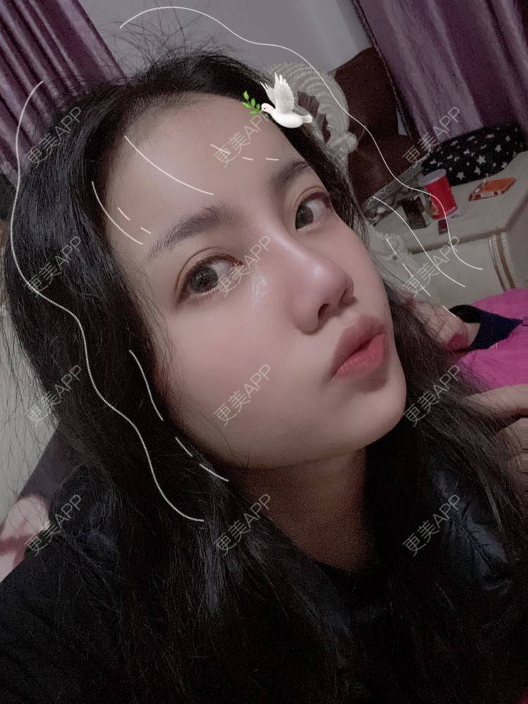 更美 - Dd酱哦的隆鼻经验 | 耳软骨隆鼻 | 硅胶隆鼻 | 隆鼻 | 鼻部多项 | 自体软骨垫鼻尖 | 温州