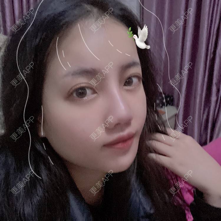 更美 - Dd酱哦的隆鼻经验 | 耳软骨隆鼻 | 硅胶隆鼻 | 隆鼻 | 鼻部多项 | 自体软骨垫鼻尖 | 温州
