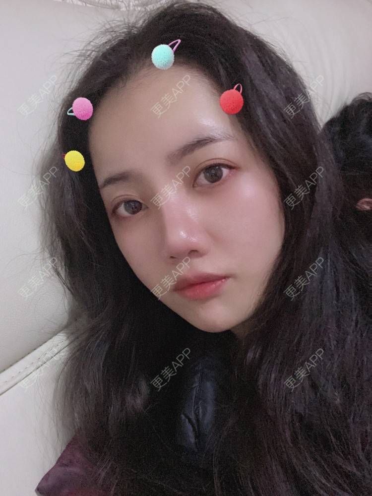 更美 - Dd酱哦的隆鼻经验 | 耳软骨隆鼻 | 硅胶隆鼻 | 隆鼻 | 鼻部多项 | 自体软骨垫鼻尖 | 温州