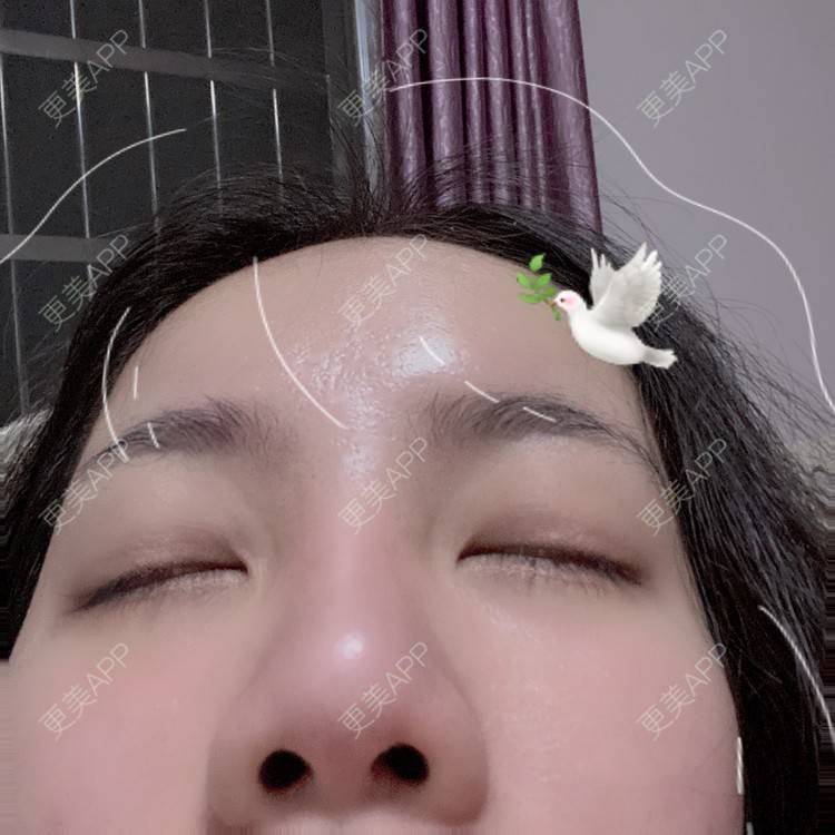 更美 - Dd酱哦的隆鼻经验 | 耳软骨隆鼻 | 硅胶隆鼻 | 隆鼻 | 鼻部多项 | 自体软骨垫鼻尖 | 温州