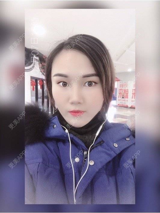 更美 - 安迪🌷的玻尿酸面颊经验 | 视频日记 | 上海 | 玻尿酸面颊