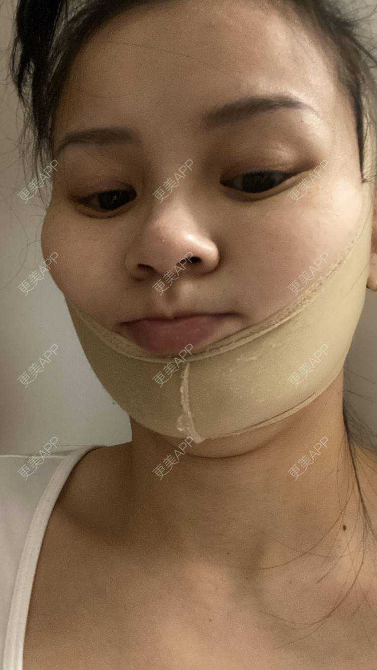 更美 - 一白遮三丑丑丑的吸脂瘦脸经验 | 吸脂瘦脸 | 激光溶脂瘦脸 | 上海 | 射频溶脂