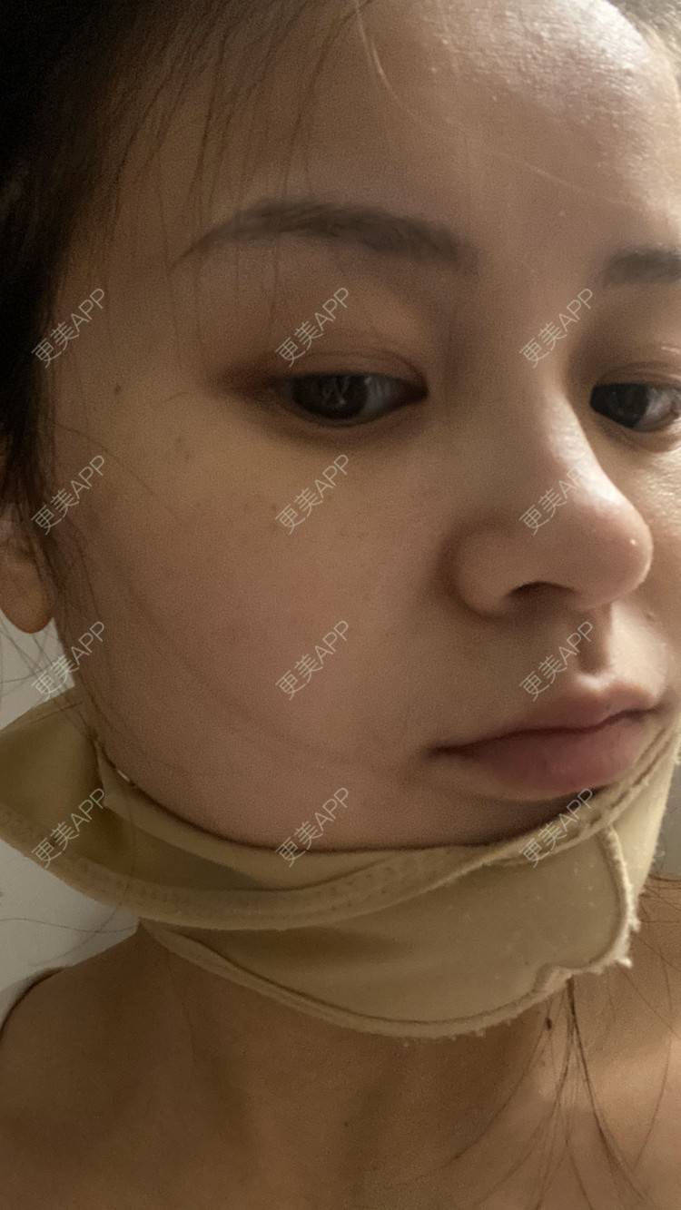 更美 - 一白遮三丑丑丑的吸脂瘦脸经验 | 吸脂瘦脸 | 激光溶脂瘦脸 | 上海 | 射频溶脂