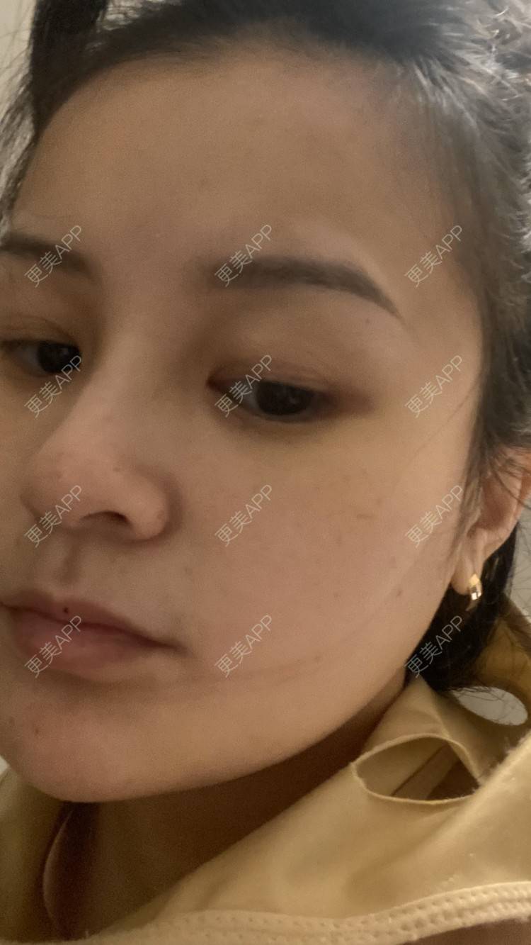 更美 - 一白遮三丑丑丑的吸脂瘦脸经验 | 吸脂瘦脸 | 激光溶脂瘦脸 | 上海 | 射频溶脂