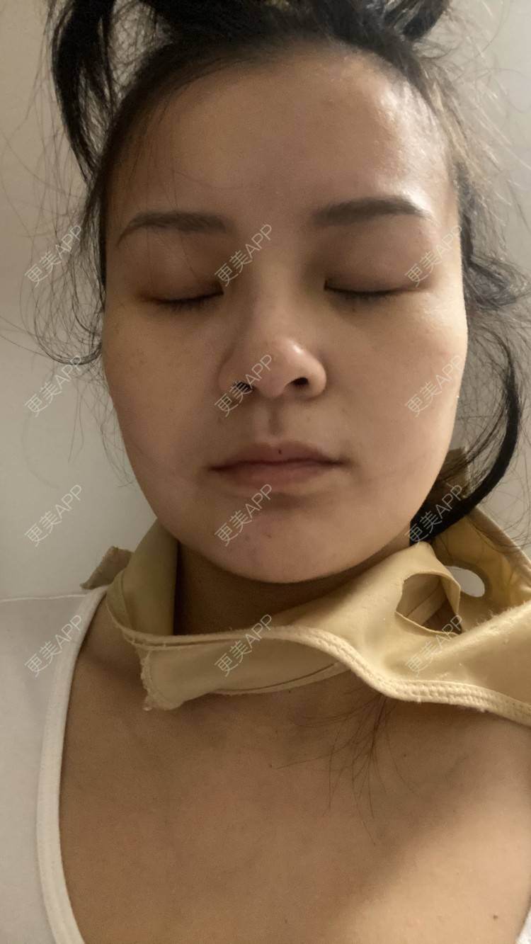 更美 - 一白遮三丑丑丑的吸脂瘦脸经验 | 吸脂瘦脸 | 激光溶脂瘦脸 | 上海 | 射频溶脂