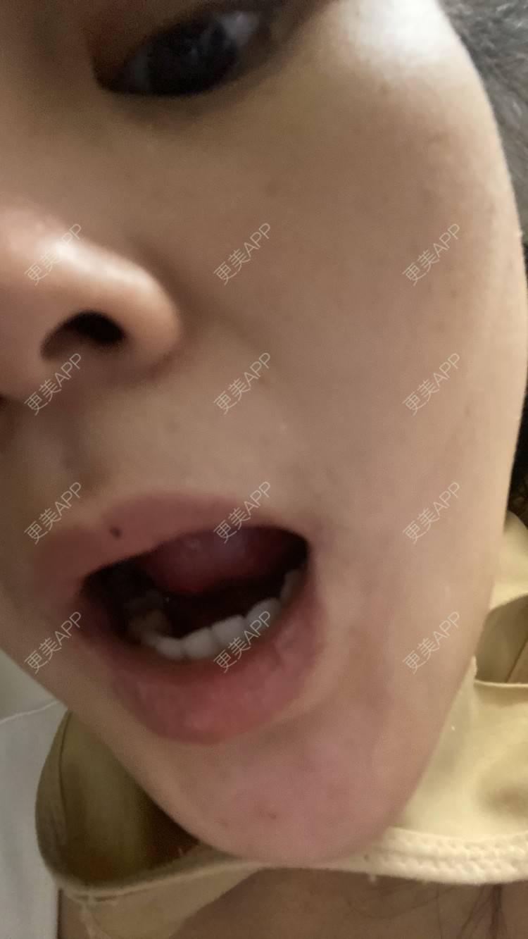 更美 - 一白遮三丑丑丑的吸脂瘦脸经验 | 吸脂瘦脸 | 激光溶脂瘦脸 | 上海 | 射频溶脂