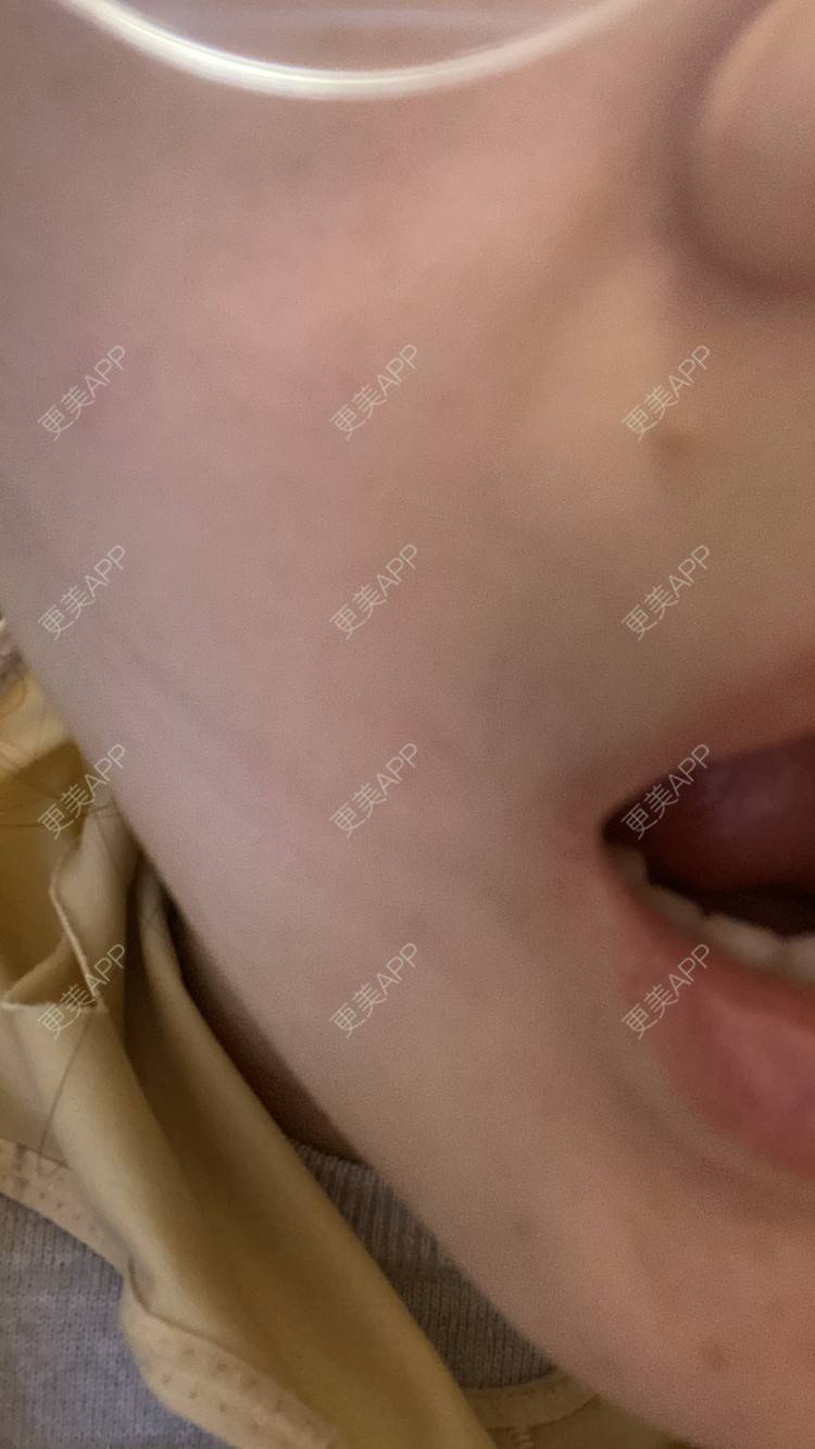 更美 - 一白遮三丑丑丑的吸脂瘦脸经验 | 吸脂瘦脸 | 激光溶脂瘦脸 | 上海 | 射频溶脂