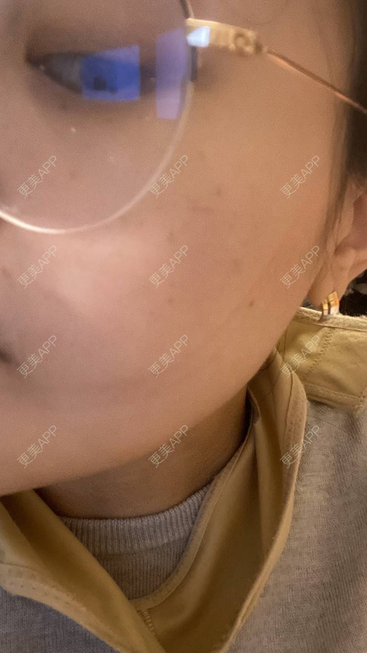 更美 - 一白遮三丑丑丑的吸脂瘦脸经验 | 吸脂瘦脸 | 激光溶脂瘦脸 | 上海 | 射频溶脂