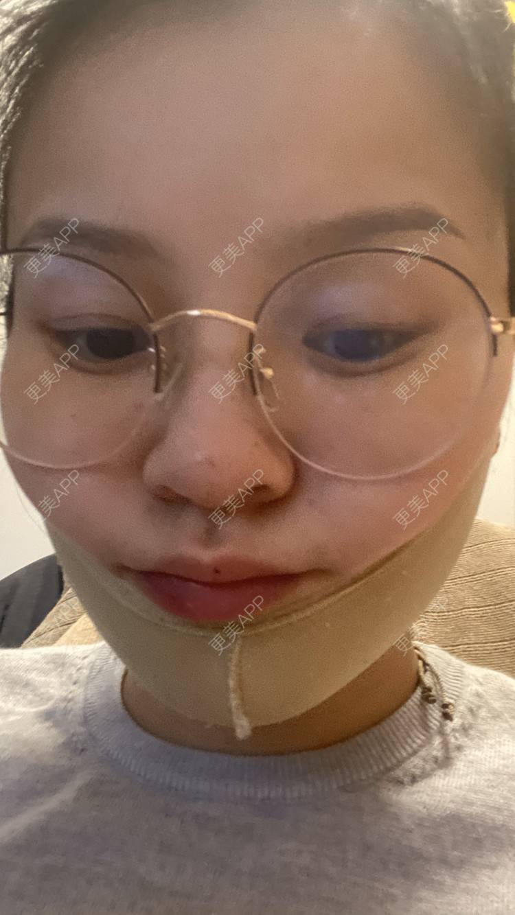 更美 - 一白遮三丑丑丑的吸脂瘦脸经验 | 吸脂瘦脸 | 激光溶脂瘦脸 | 上海 | 射频溶脂