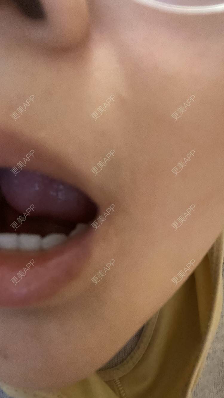 更美 - 一白遮三丑丑丑的吸脂瘦脸经验 | 吸脂瘦脸 | 激光溶脂瘦脸 | 上海 | 射频溶脂