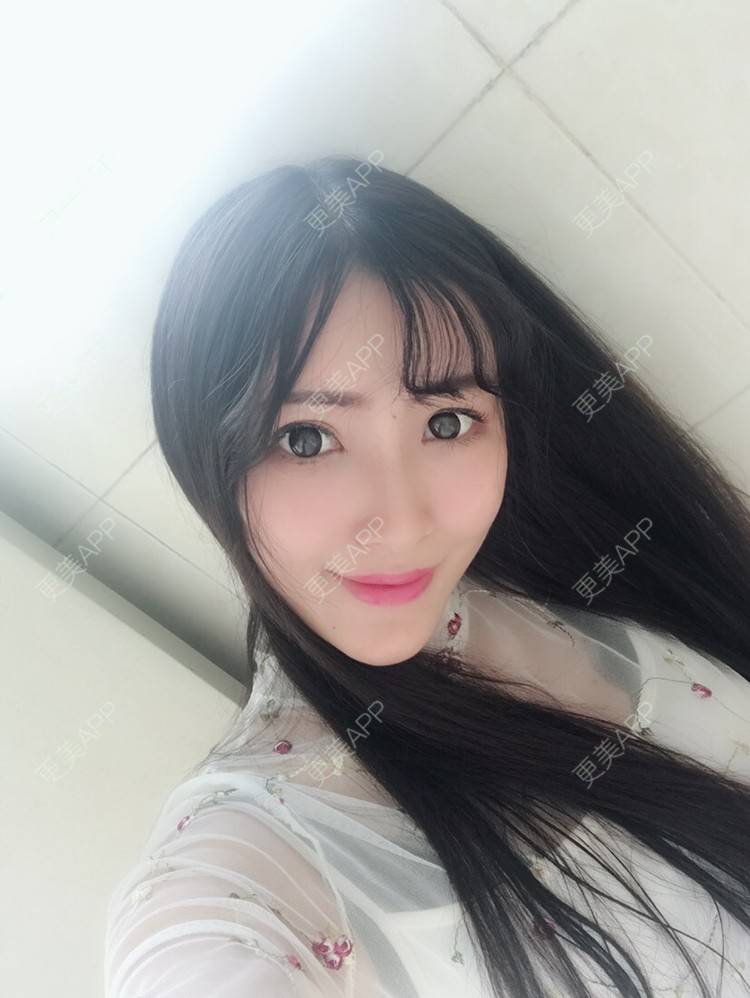 陈莎.的自体脂肪全面部填充