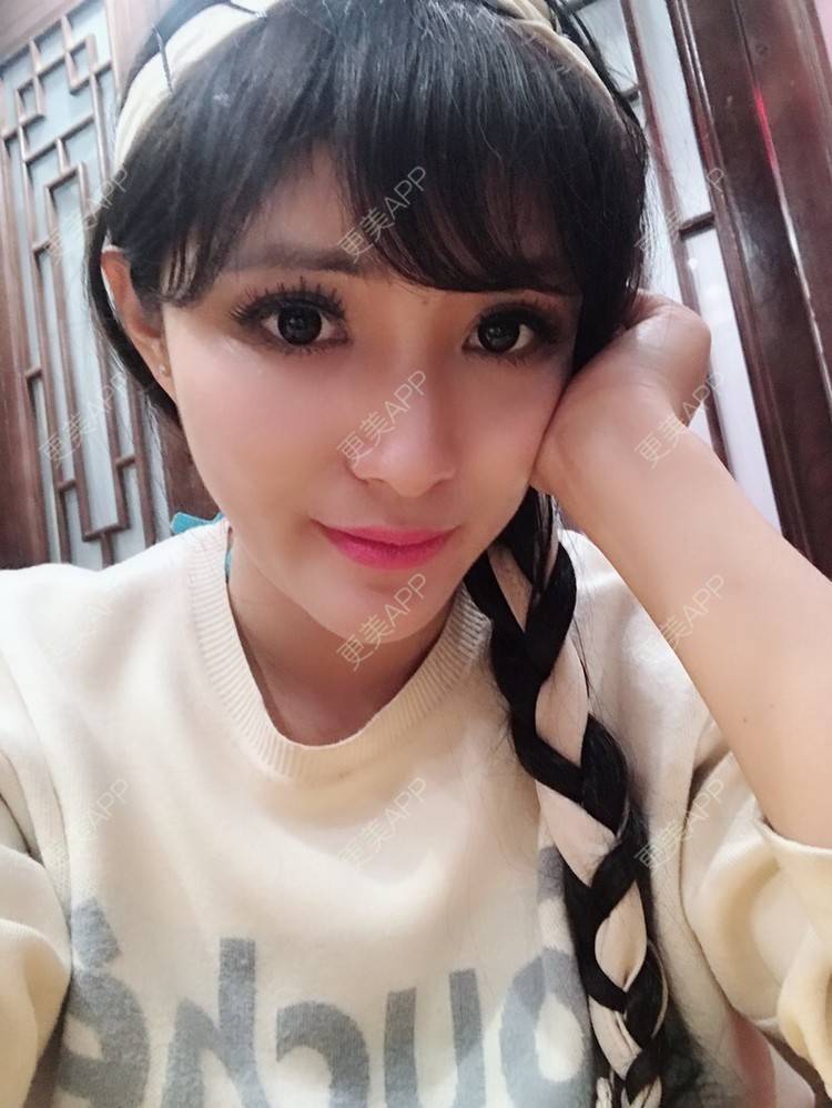 陈莎.的自体脂肪全面部填充