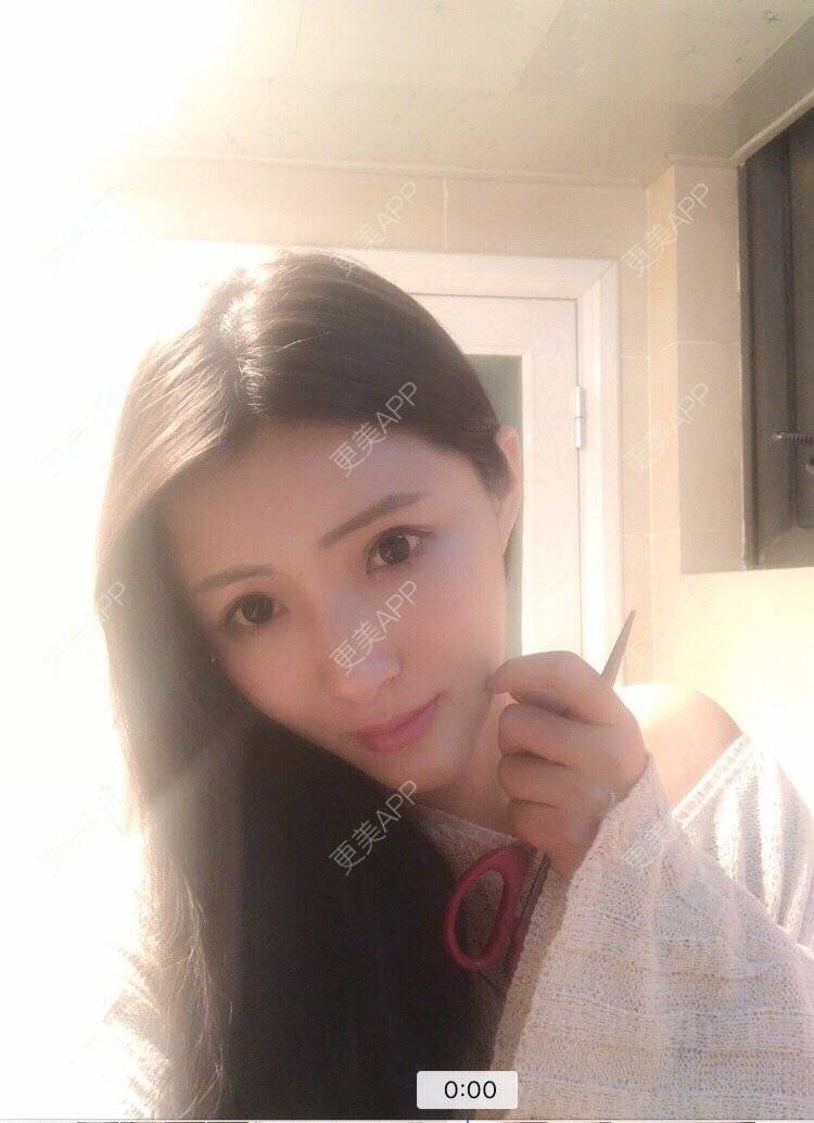 陈莎.的自体脂肪全面部填充