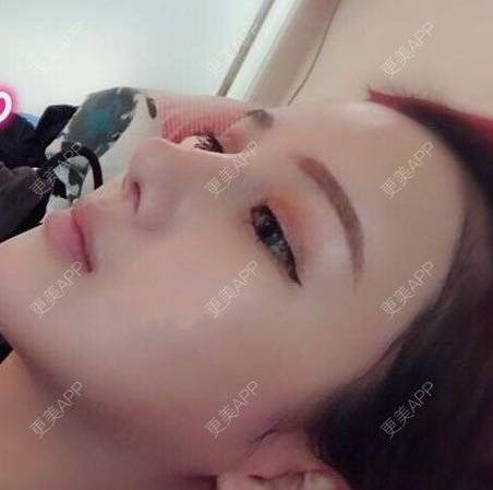 更美 - 待到花开静谧时~的耳软骨隆鼻经验 | 耳软骨隆鼻