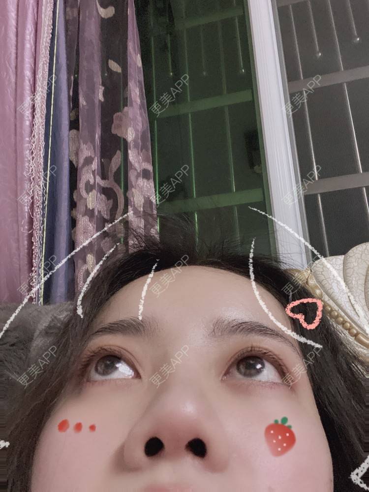 更美 - Dd酱哦的隆鼻经验 | 硅胶隆鼻 | 耳软骨隆鼻 | 隆鼻 | 鼻部多项 | 自体软骨垫鼻尖 | 温州