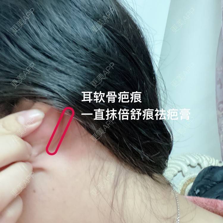 更美 - Dd酱哦的隆鼻经验 | 硅胶隆鼻 | 耳软骨隆鼻 | 隆鼻 | 鼻部多项 | 自体软骨垫鼻尖 | 温州