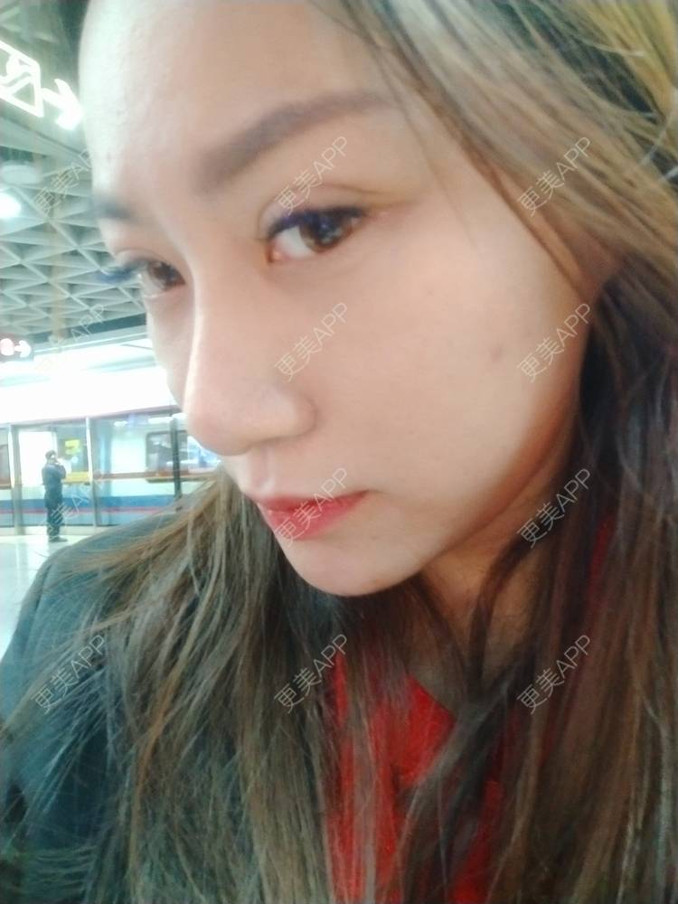 更美 - 逗逗是剩女的双眼皮经验 | 全切双眼皮 | 广州 | 埋线隆鼻 | 视频日记