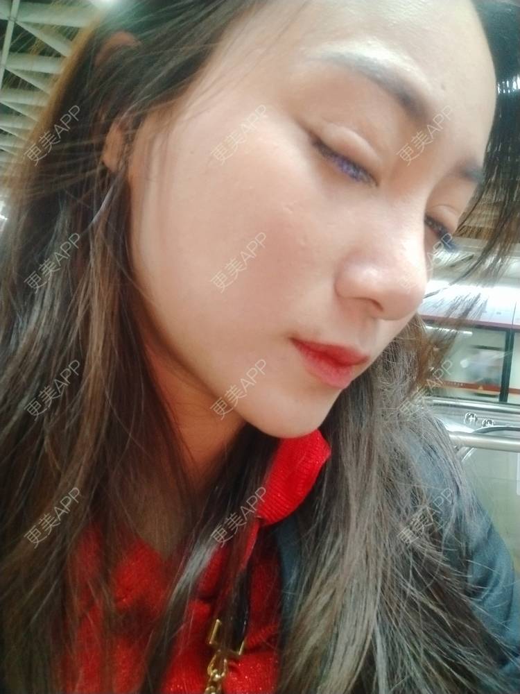 更美 - 逗逗是剩女的双眼皮经验 | 全切双眼皮 | 广州 | 埋线隆鼻 | 视频日记