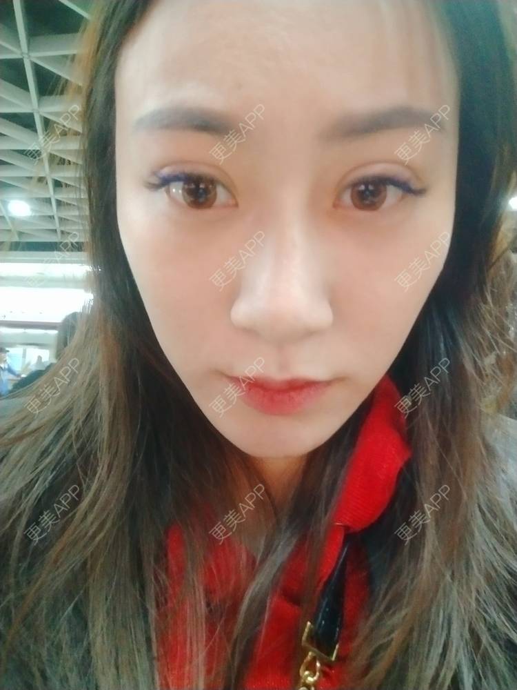 更美 - 逗逗是剩女的双眼皮经验 | 全切双眼皮 | 广州 | 埋线隆鼻 | 视频日记