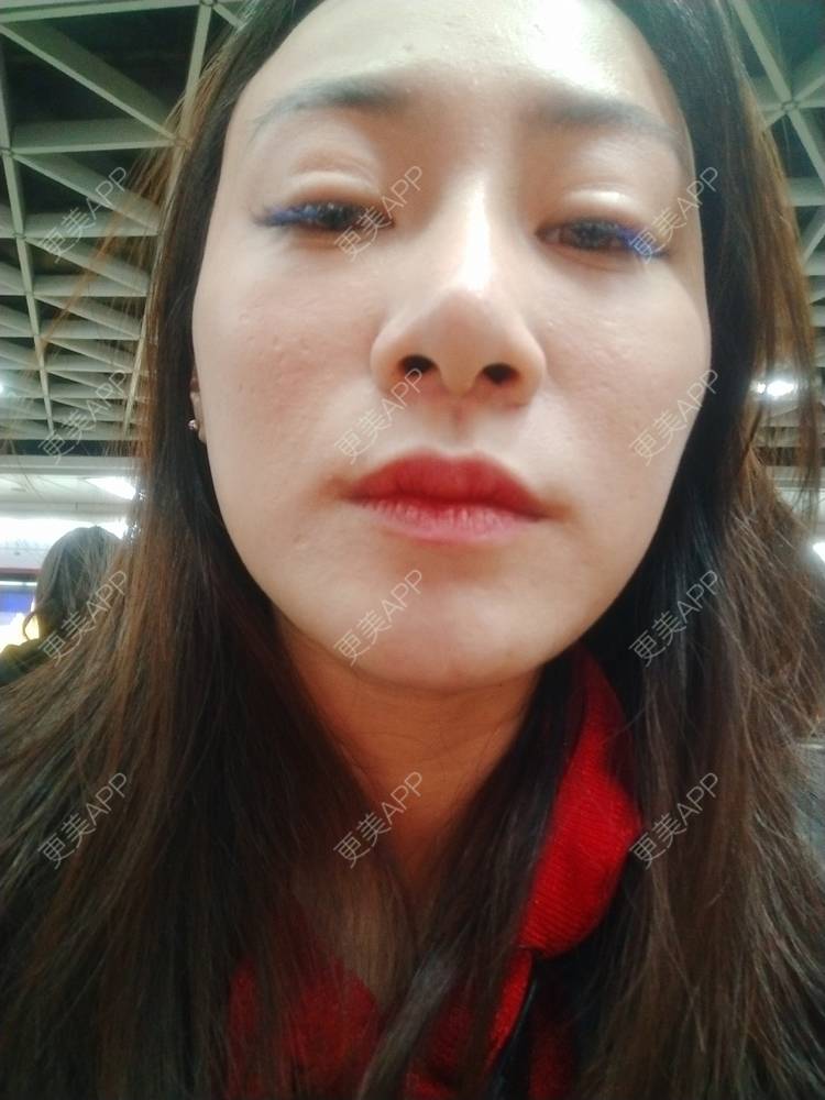 更美 - 逗逗是剩女的双眼皮经验 | 全切双眼皮 | 广州 | 埋线隆鼻 | 视频日记