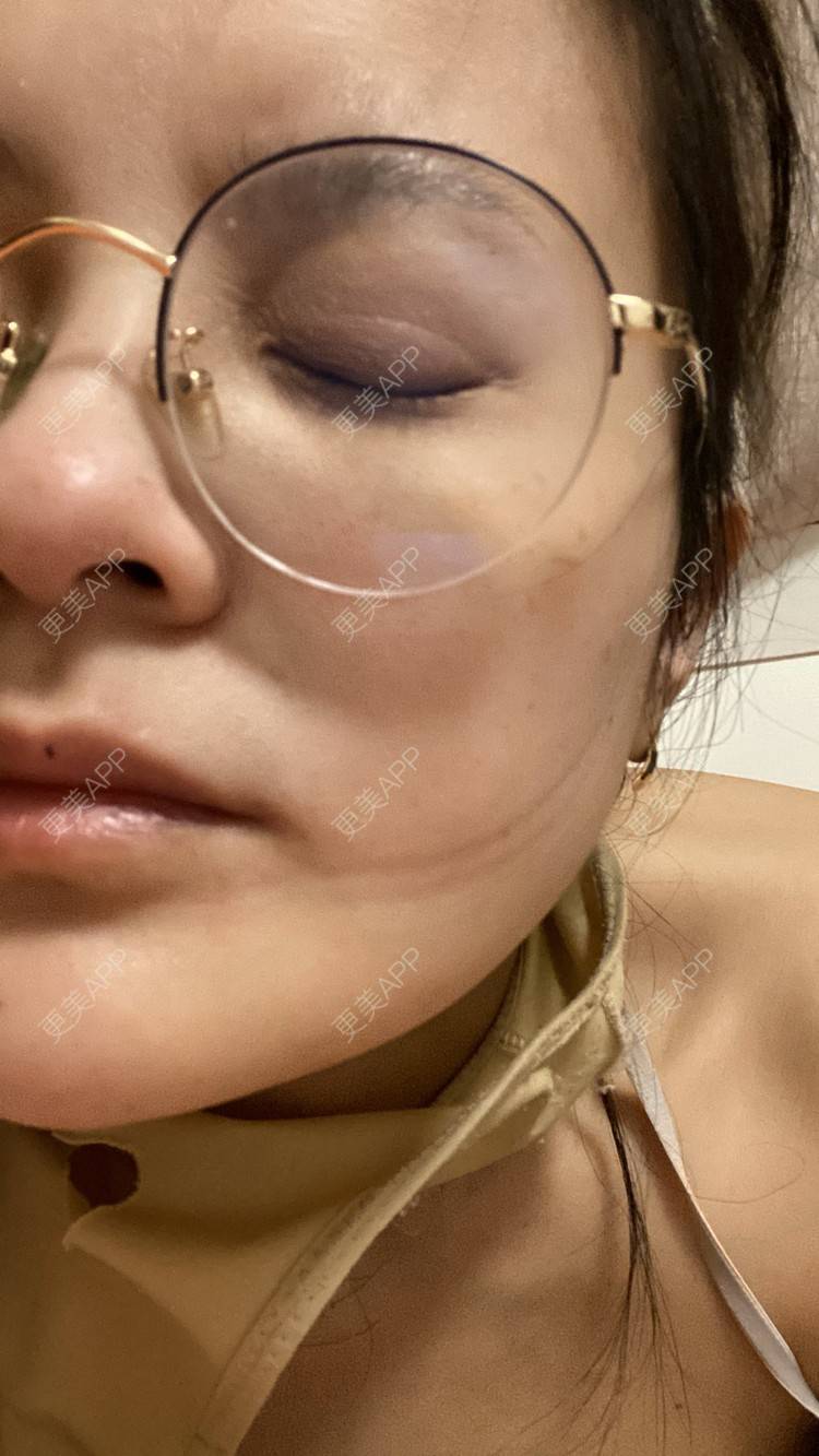 更美 - 一白遮三丑丑丑的吸脂瘦脸经验 | 吸脂瘦脸 | 激光溶脂瘦脸 | 上海 | 射频溶脂