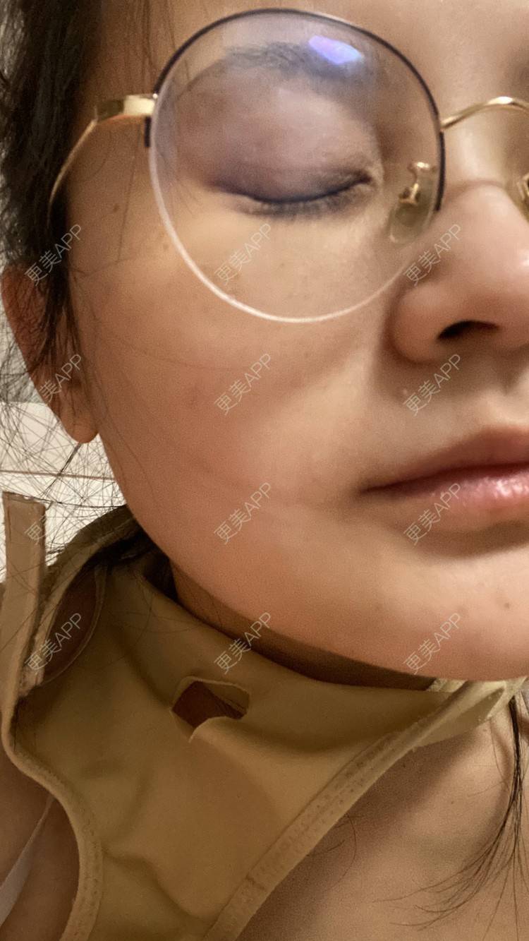 更美 - 一白遮三丑丑丑的吸脂瘦脸经验 | 吸脂瘦脸 | 激光溶脂瘦脸 | 上海 | 射频溶脂