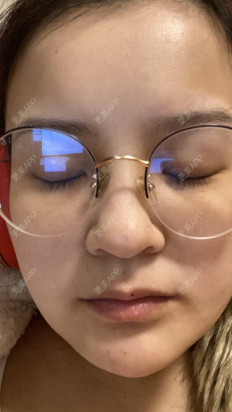 更美 - 一白遮三丑丑丑的吸脂瘦脸经验 | 射频溶脂 | 吸脂瘦脸 | 激光溶脂瘦脸 | 上海