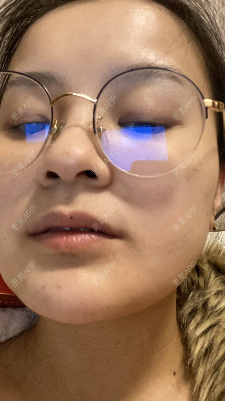 更美 - 一白遮三丑丑丑的吸脂瘦脸经验 | 射频溶脂 | 吸脂瘦脸 | 激光溶脂瘦脸 | 上海