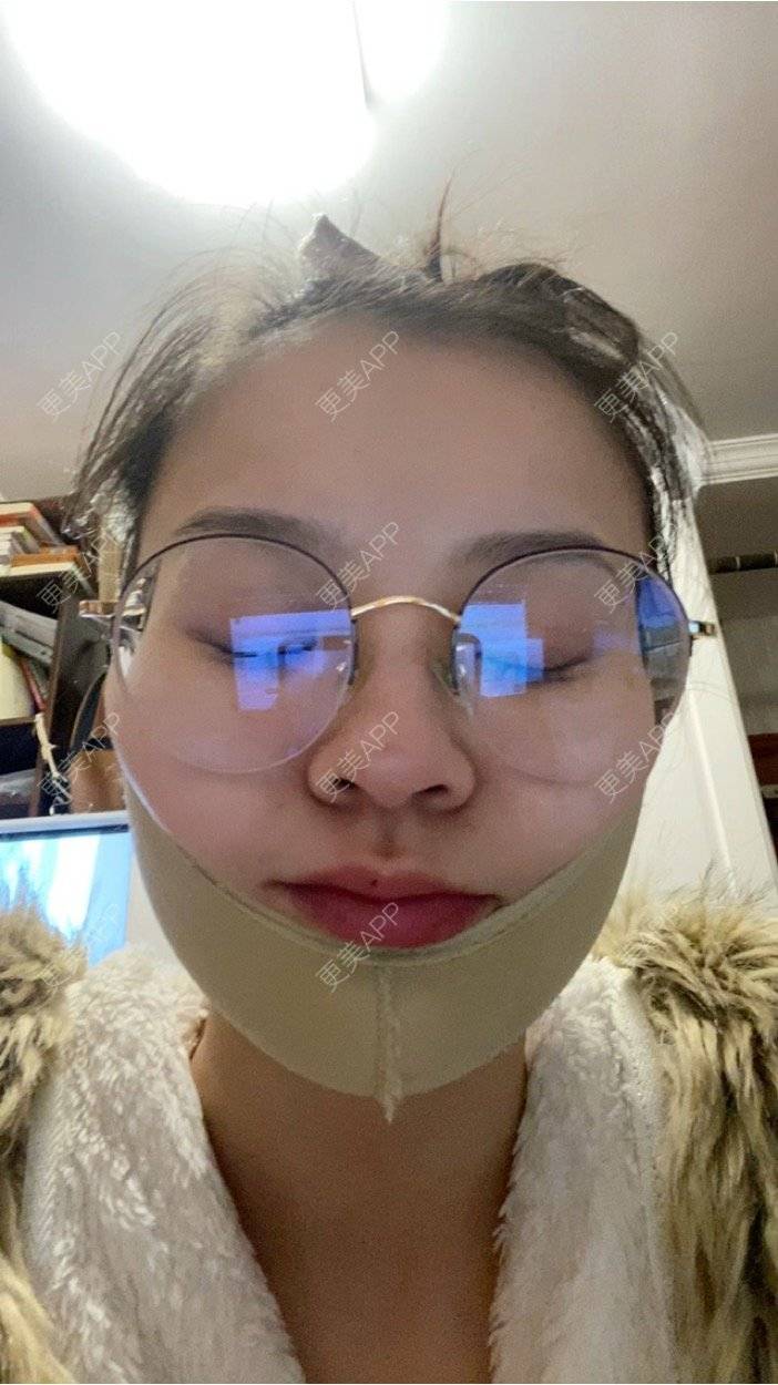 更美 - 一白遮三丑丑丑的吸脂瘦脸经验 | 射频溶脂 | 吸脂瘦脸 | 激光溶脂瘦脸 | 上海