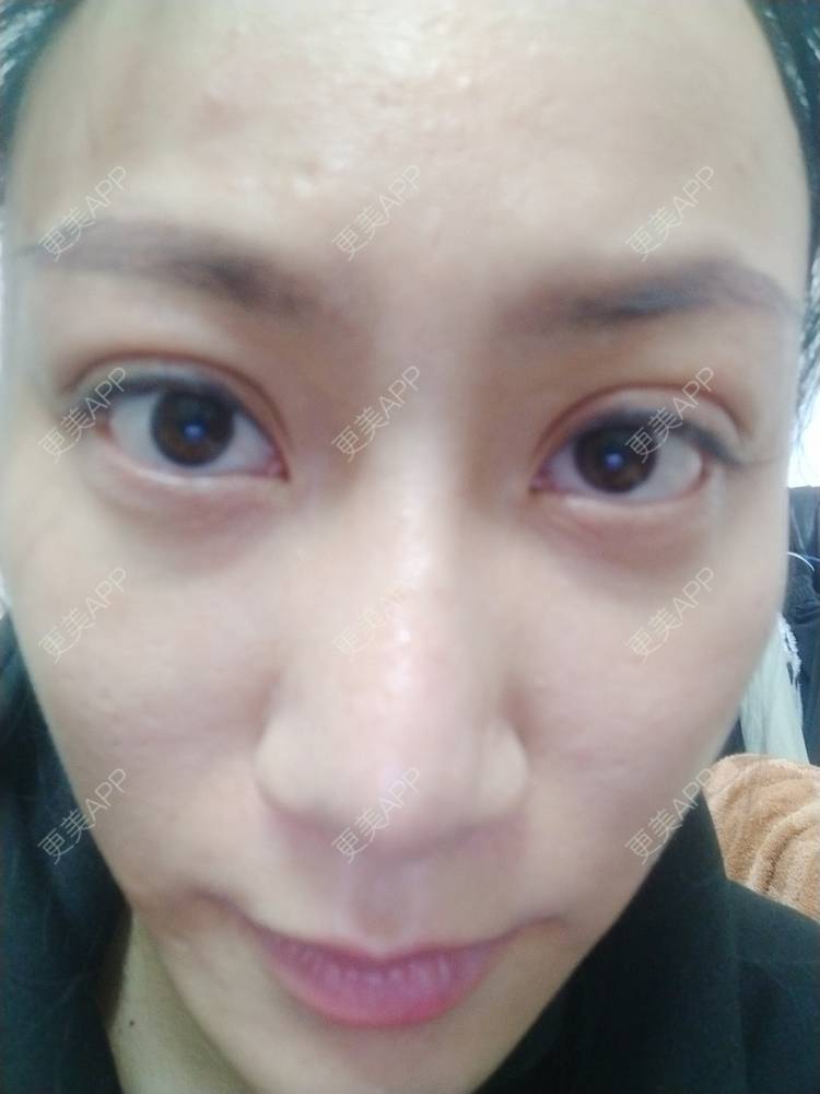 更美 - 逗逗是剩女的双眼皮经验 | 全切双眼皮 | 广州 | 埋线隆鼻 | 视频日记