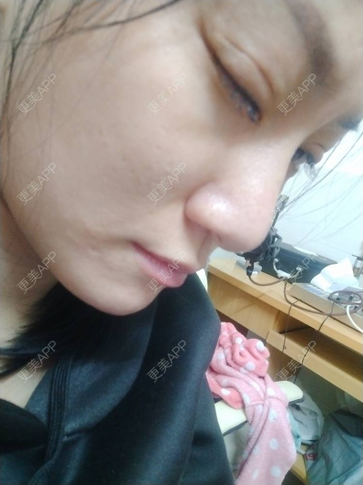 更美 - 逗逗是剩女的双眼皮经验 | 全切双眼皮 | 广州 | 埋线隆鼻 | 视频日记
