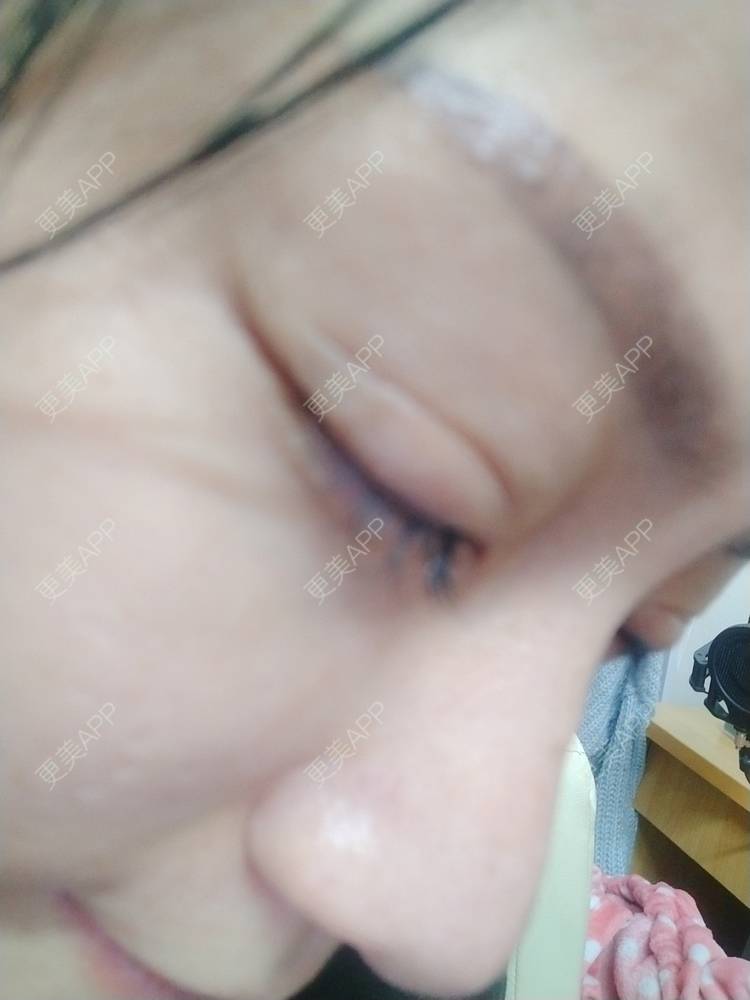 更美 - 逗逗是剩女的双眼皮经验 | 全切双眼皮 | 广州 | 埋线隆鼻 | 视频日记