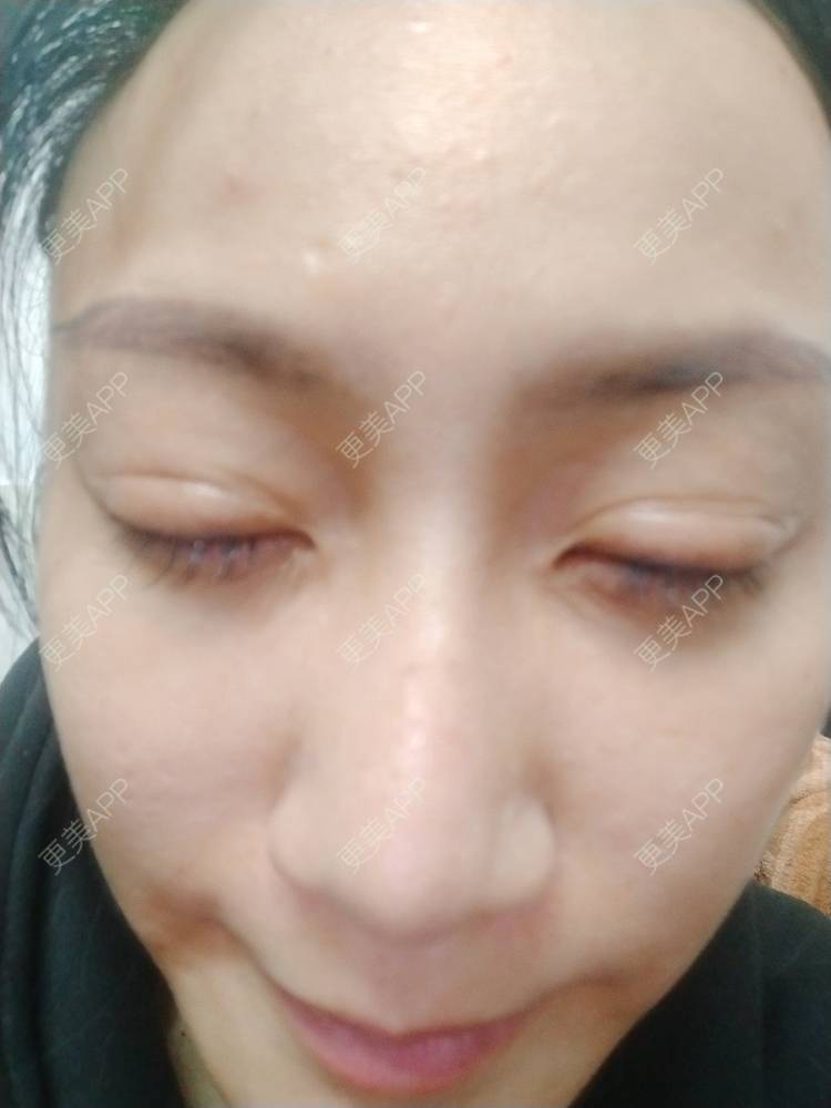 更美 - 逗逗是剩女的双眼皮经验 | 全切双眼皮 | 广州 | 埋线隆鼻 | 视频日记