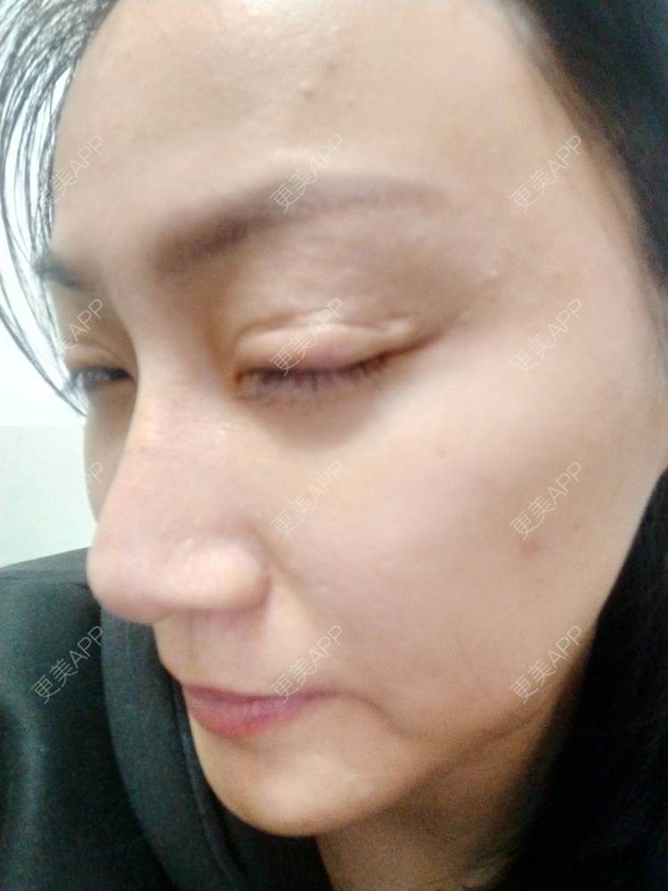 更美 - 逗逗是剩女的双眼皮经验 | 全切双眼皮 | 广州 | 埋线隆鼻 | 视频日记