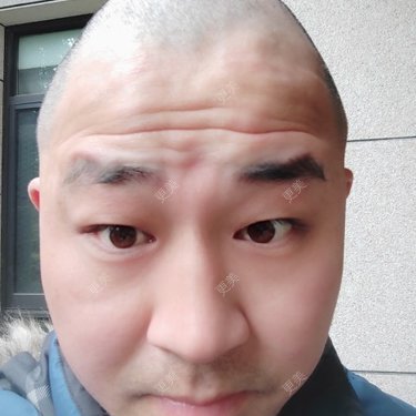 本人额头有抬头纹静态的横纹细纹想除皱想请大家帮忙提宝贵的意见