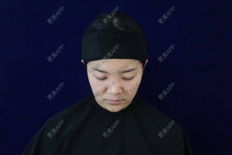 更美 - 池鱼九的耳软骨隆鼻经验 | 耳软骨隆鼻 | 硅胶隆鼻 | 肋软骨隆鼻 | 膨体隆鼻 | 鼻部多项 | 长沙