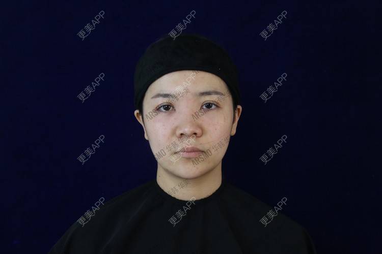 更美 - 池鱼九的耳软骨隆鼻经验 | 耳软骨隆鼻 | 硅胶隆鼻 | 肋软骨隆鼻 | 膨体隆鼻 | 鼻部多项 | 长沙