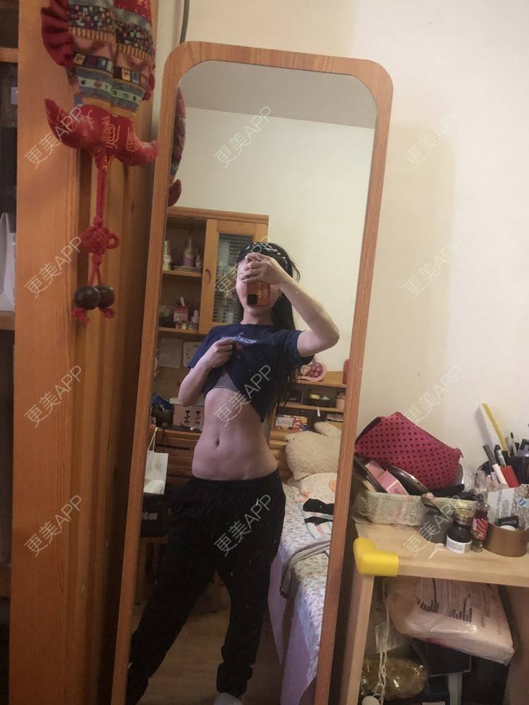 更美 - XXX||XXX的腰腹吸脂经验 | 腰腹吸脂 | 背部吸脂 | 手臂吸脂 | 郑州