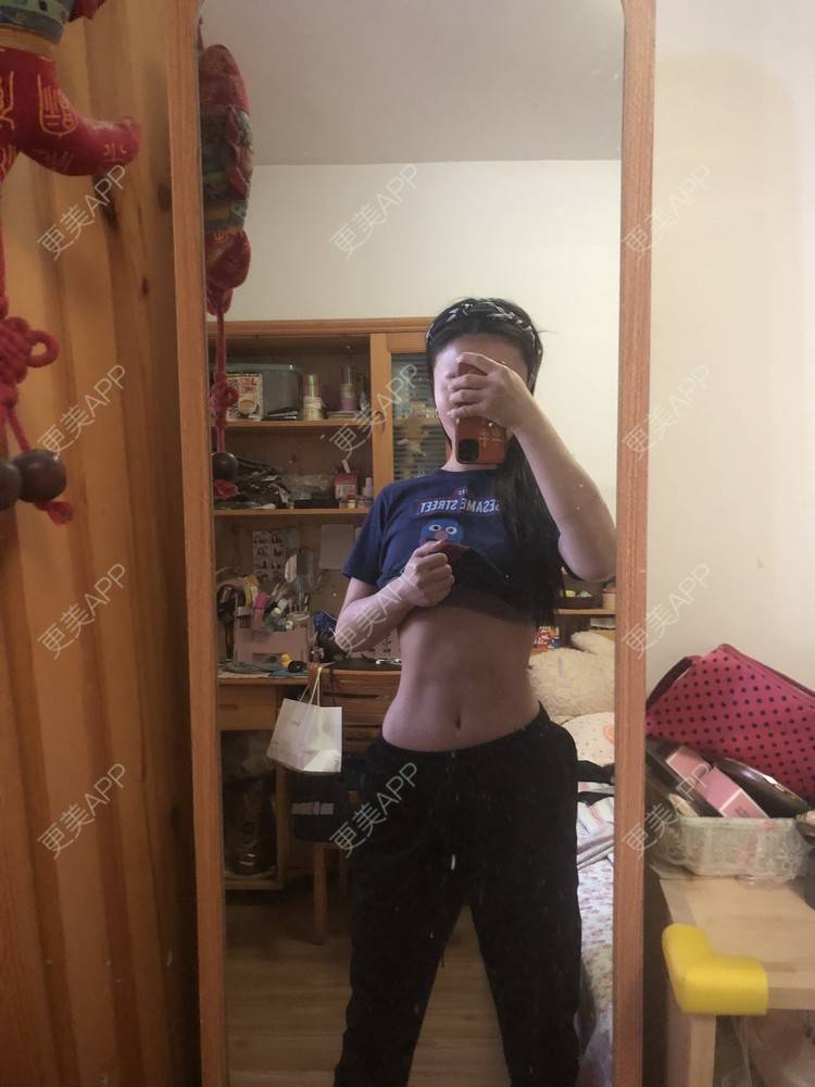 更美 - XXX||XXX的腰腹吸脂经验 | 腰腹吸脂 | 背部吸脂 | 手臂吸脂 | 郑州