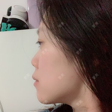 凸嘴矫正