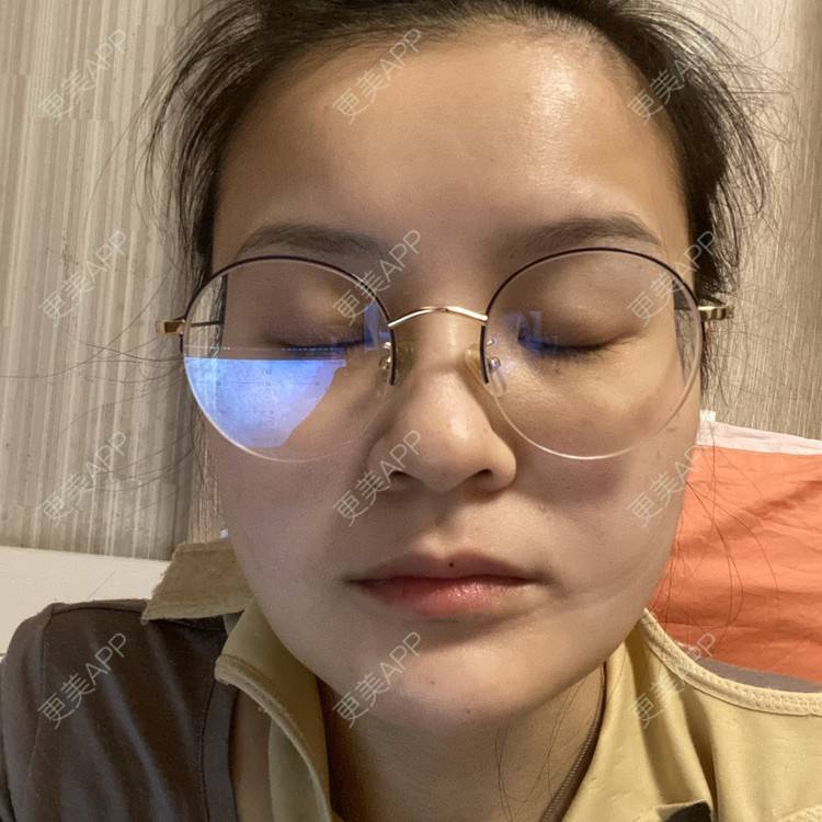 更美 - 一白遮三丑丑丑的吸脂瘦脸经验 | 吸脂瘦脸 | 射频溶脂 | 激光溶脂瘦脸 | 上海