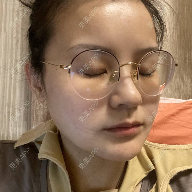 更美 - 一白遮三丑丑丑的吸脂瘦脸经验 | 吸脂瘦脸 | 射频溶脂 | 激光溶脂瘦脸 | 上海