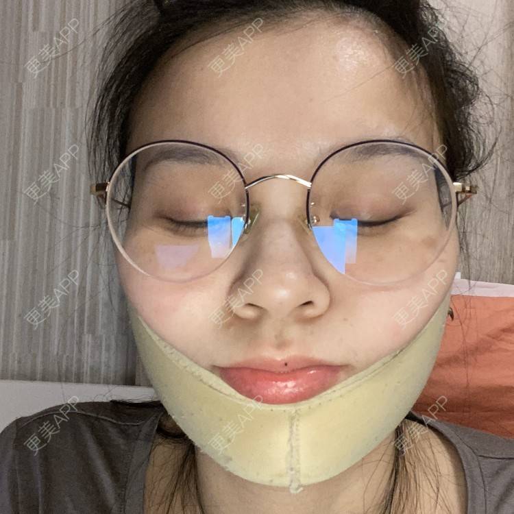 更美 - 一白遮三丑丑丑的吸脂瘦脸经验 | 吸脂瘦脸 | 射频溶脂 | 激光溶脂瘦脸 | 上海