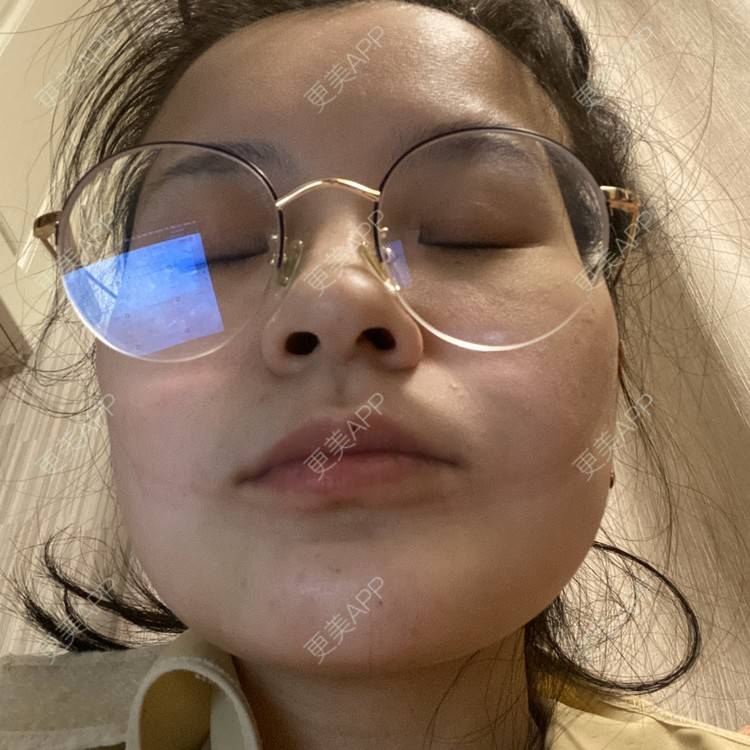 更美 - 一白遮三丑丑丑的吸脂瘦脸经验 | 吸脂瘦脸 | 射频溶脂 | 激光溶脂瘦脸 | 上海